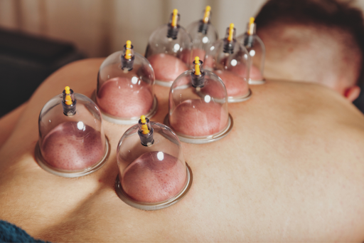 Dry Cupping Therapy