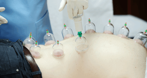 Cupping Therapy for Cellulite