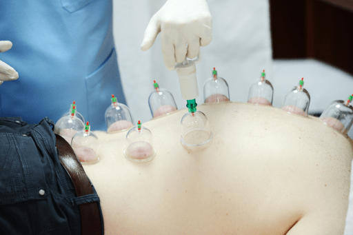 Cupping Therapy for Cellulite