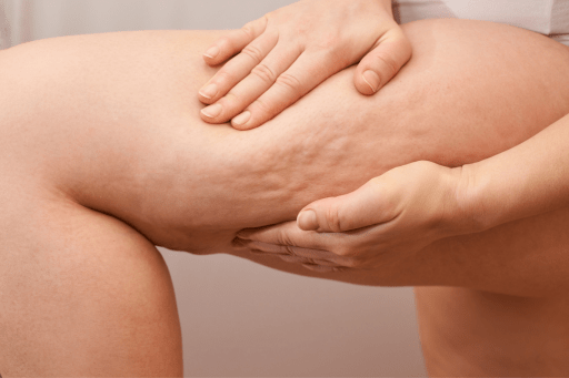 What Is Cellulite