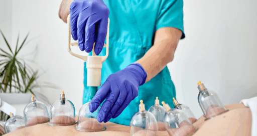 Cupping Therapy Cost in Brampton