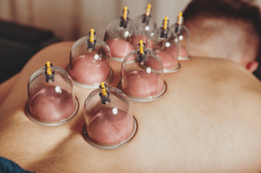 Cupping Therapy in Brampton