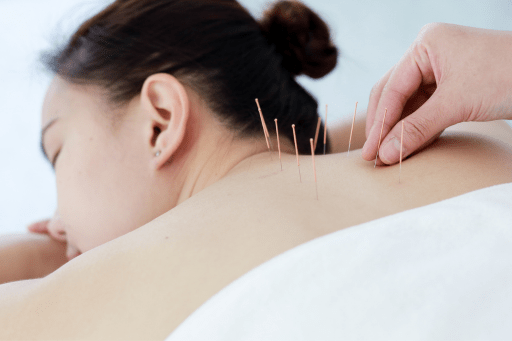 What is Acupuncture