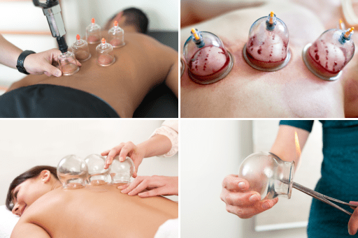 Types of Cupping Therapy