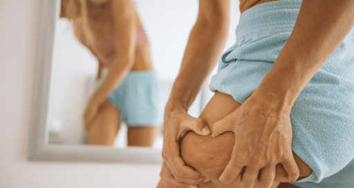 Cellulite vs Lipedema