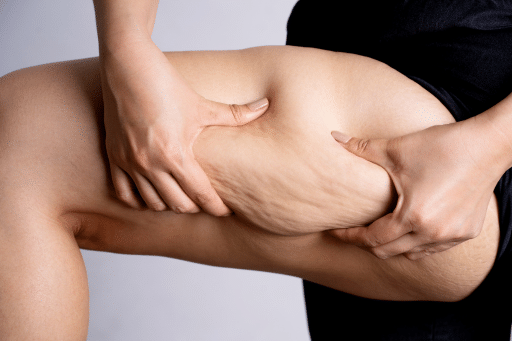 Cellulite