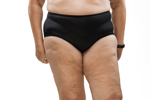 Lipedema